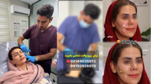 تزریق فیلر 